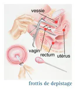 Frottis de dépistage