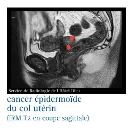 Cancer épidermoïde du col utérin